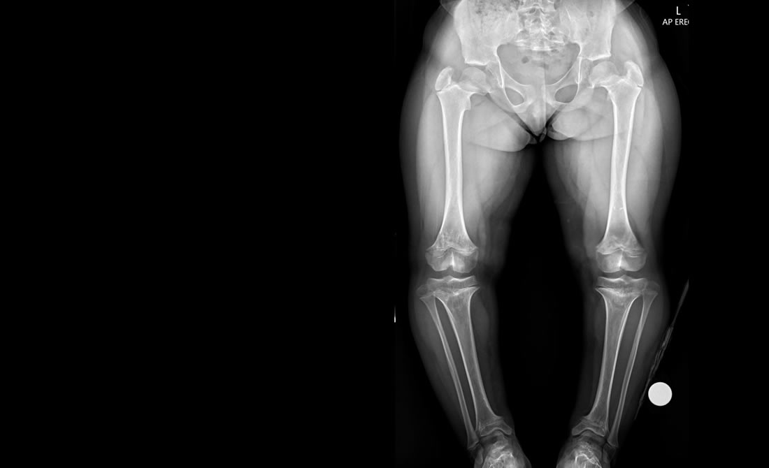 achondroplasia achondroplasia