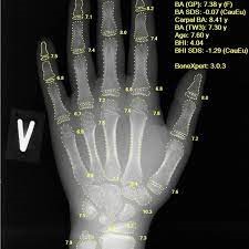 hand xray